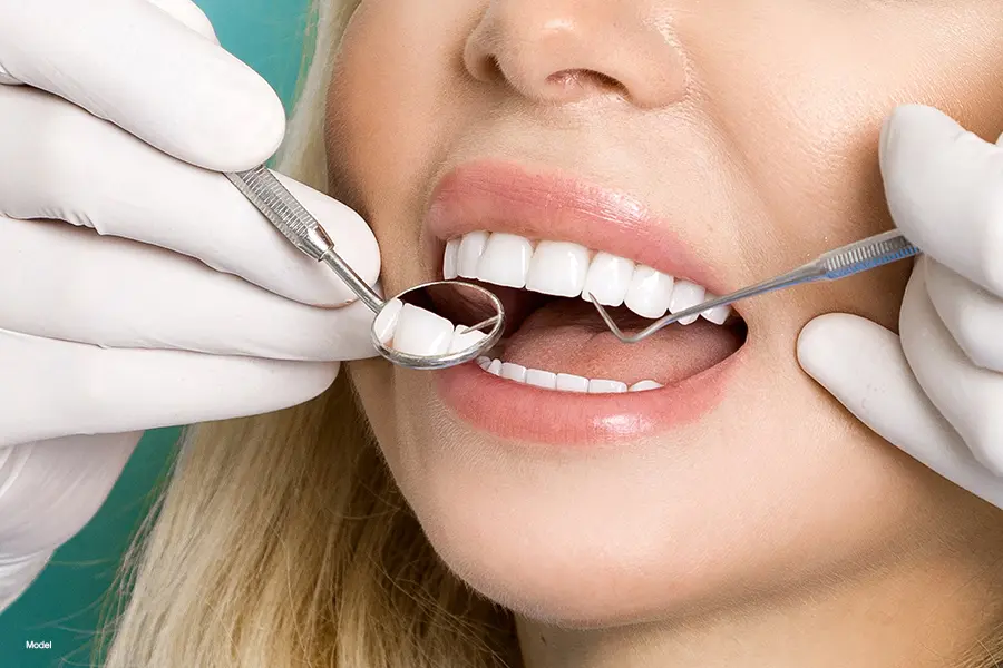 veneers-blog-model
